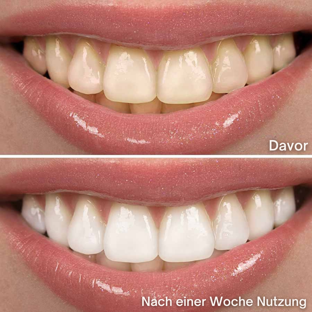 Sonic White - Schallzahnbürste für strahlend weiße Zähne