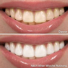 Sonic White - Schallzahnbürste für strahlend weiße Zähne